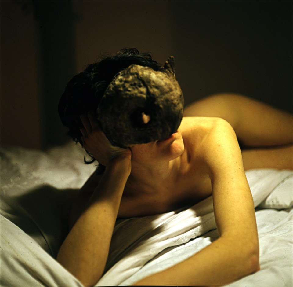 amputee’s_smooth_stump